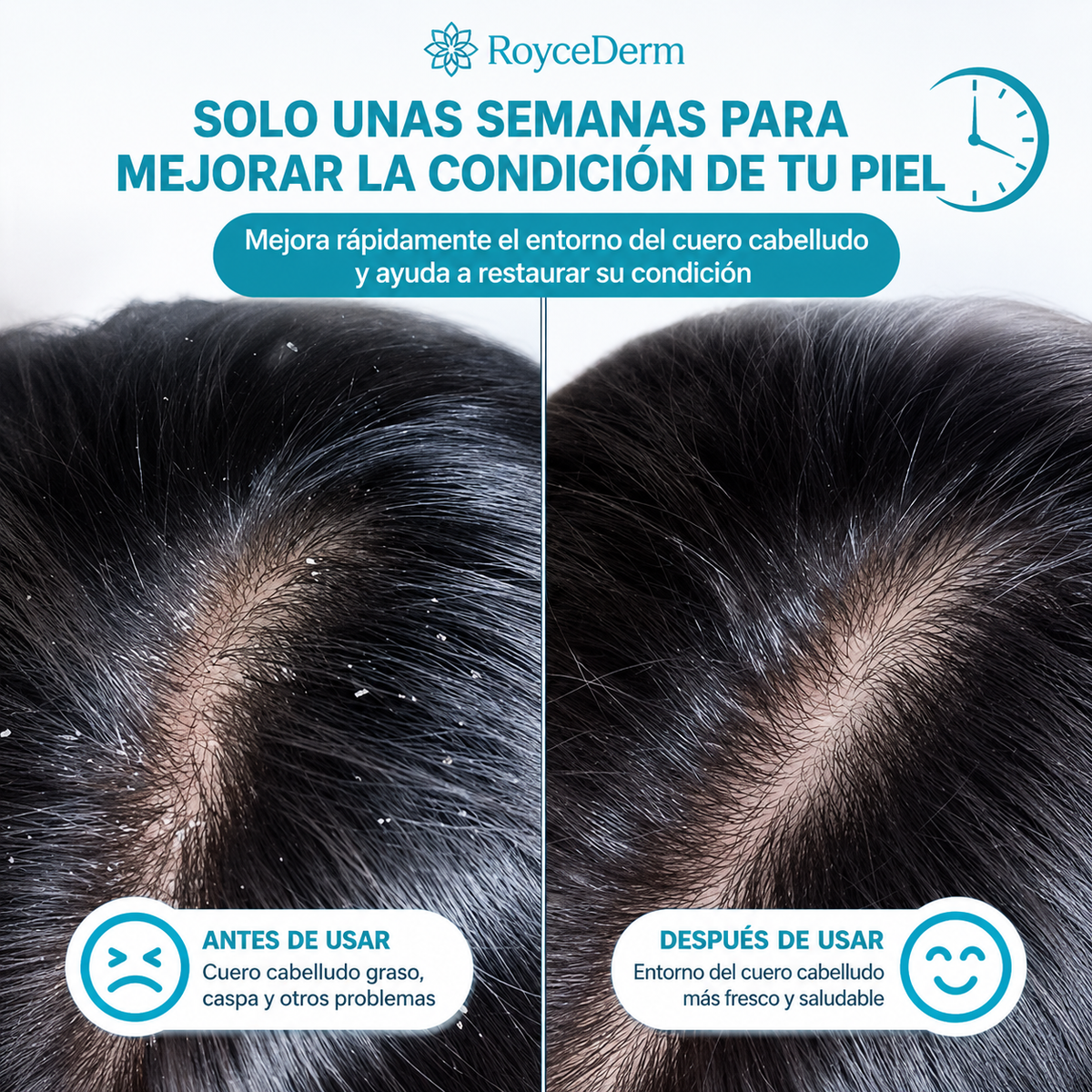 RoyceDerm Shampoo - Elimina Caspa, Psoriasis y Dermatitis Seborreica