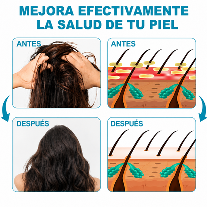 RoyceDerm Shampoo - Elimina Caspa, Psoriasis y Dermatitis Seborreica